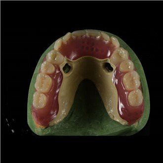 Peek Framework protēze