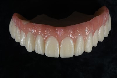 Akrila sveķu pagaidu kronis