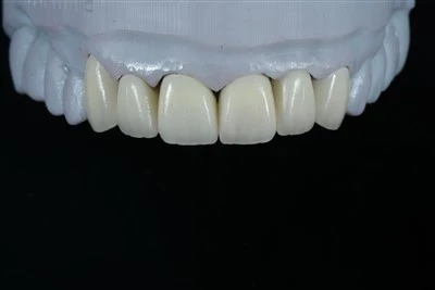 Priekšējie E.max Layering Finieri