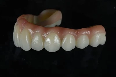 Implants-Atbalsts pilns-arkas cirkonija tilts