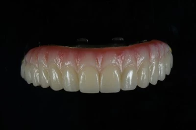 Maxillary All{0}}uz-X cirkonija tilta